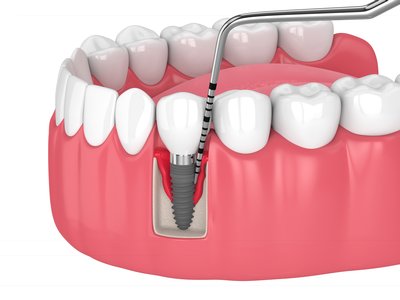 Periimplantitis